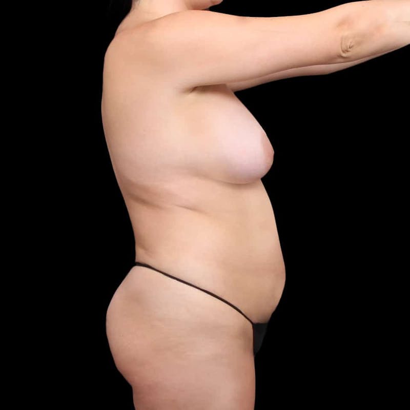 Liposuction Before & After Gallery - Patient 100759 - Image 33