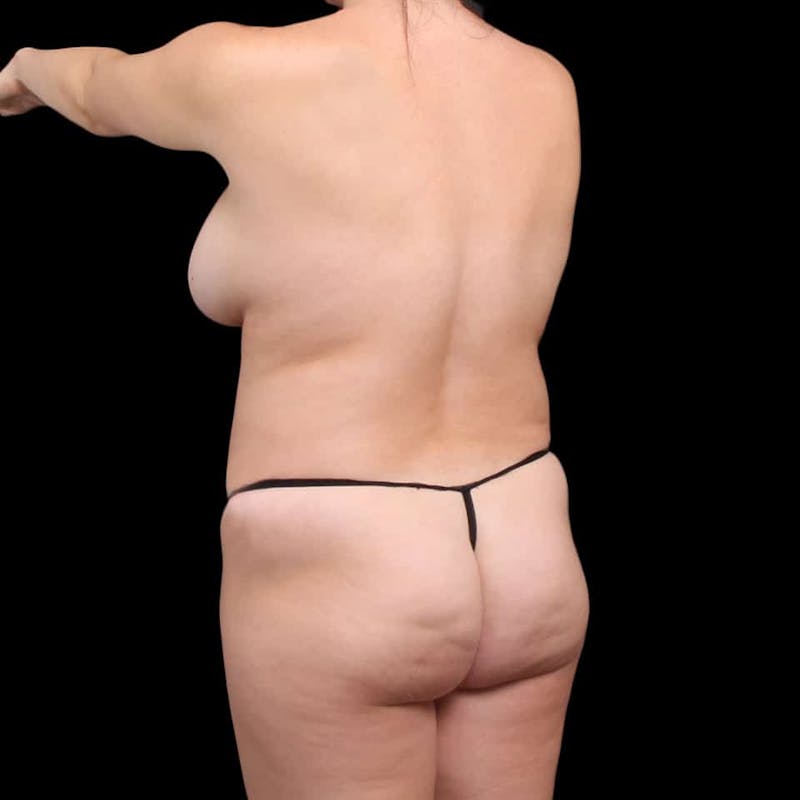 Liposuction Before & After Gallery - Patient 100759 - Image 37