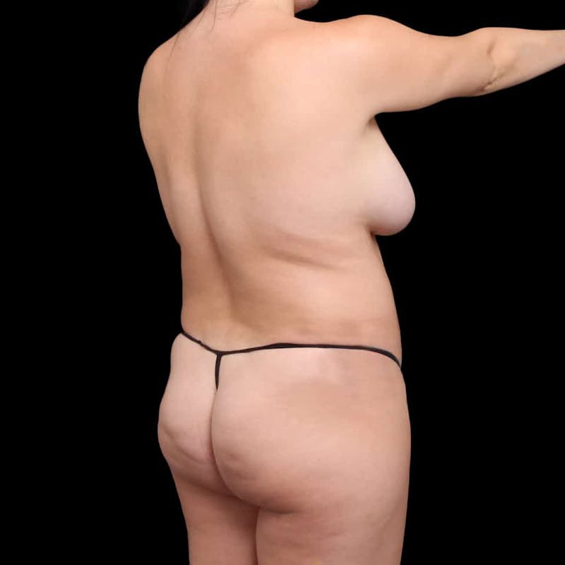 Liposuction Before & After Gallery - Patient 100759 - Image 35