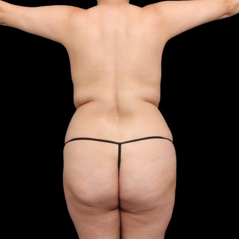 Liposuction Before & After Gallery - Patient 100759 - Image 51