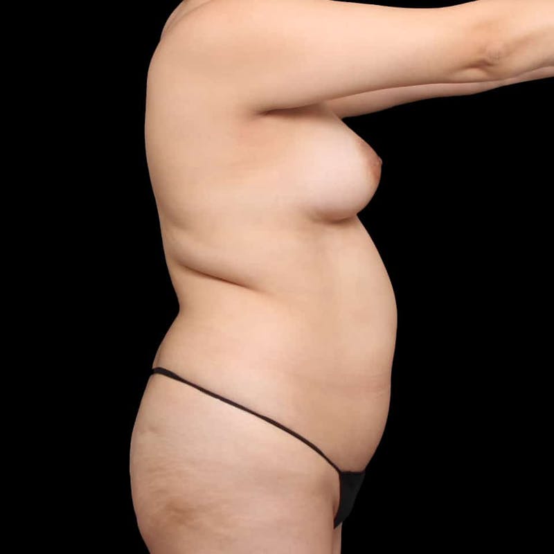 Liposuction Before & After Gallery - Patient 100759 - Image 49