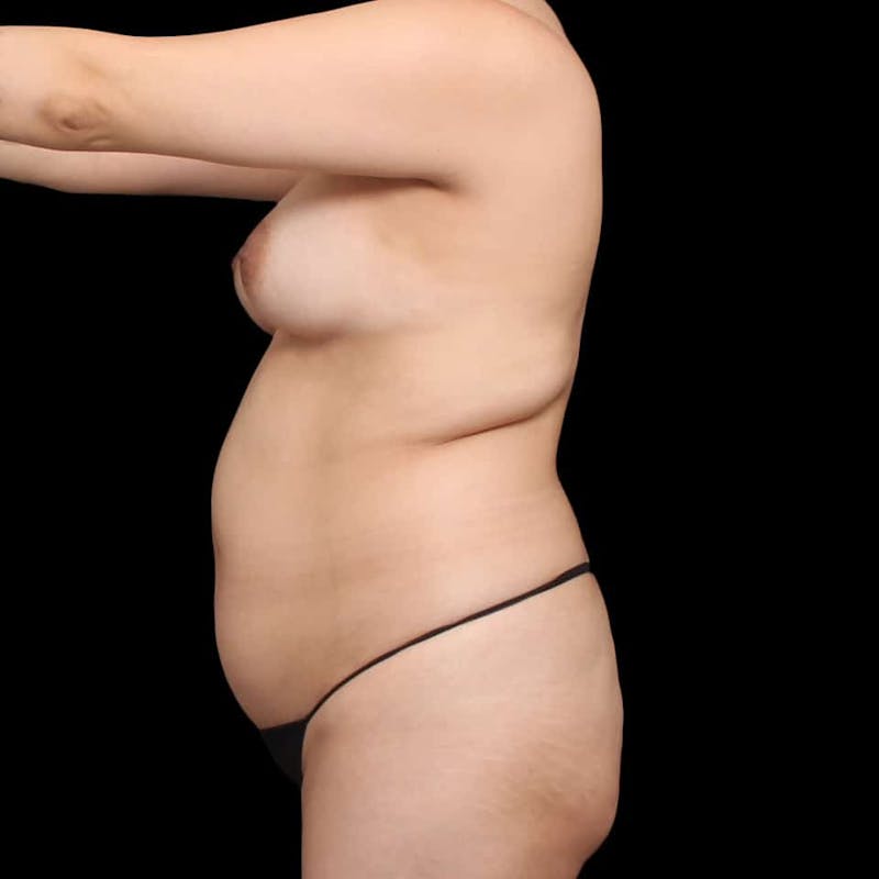 Liposuction Before & After Gallery - Patient 100759 - Image 43