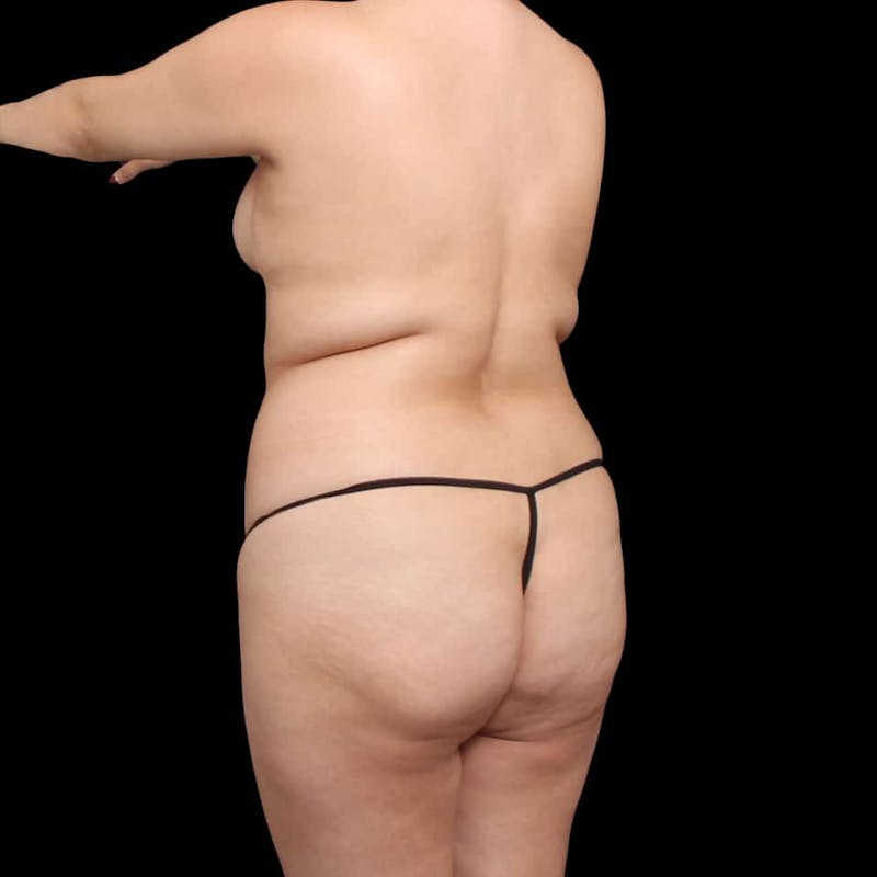 Buttock Augmentation Before & After Gallery - Patient 210253 - Image 71