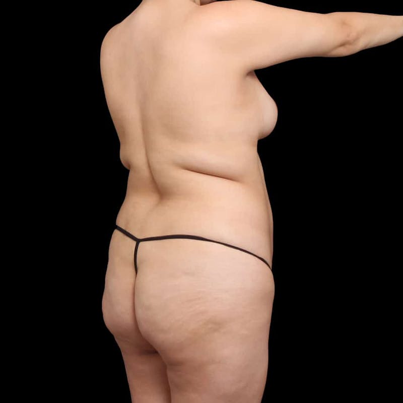 Buttock Augmentation Before & After Gallery - Patient 210253 - Image 73