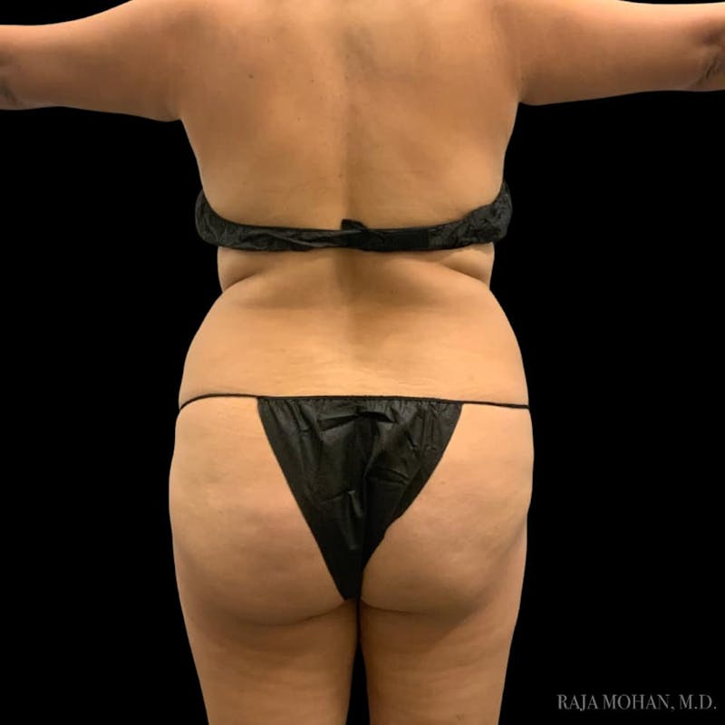 Buttock Augmentation Before & After Gallery - Patient 210253 - Image 81