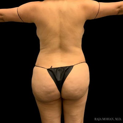 Buttock Augmentation Before & After Gallery - Patient 803430 - Image 2