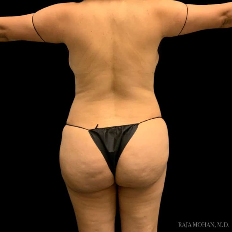 Buttock Augmentation Before & After Gallery - Patient 210253 - Image 82