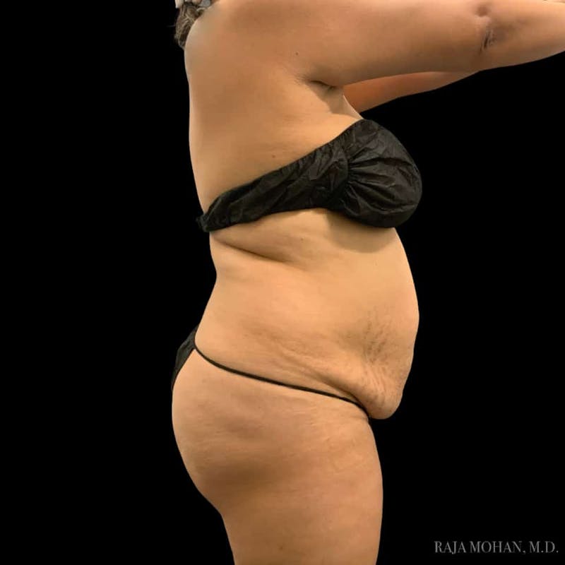 Buttock Augmentation Before & After Gallery - Patient 210253 - Image 83
