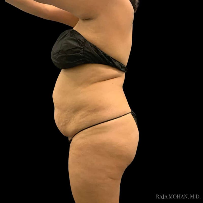 Buttock Augmentation Before & After Gallery - Patient 210253 - Image 85