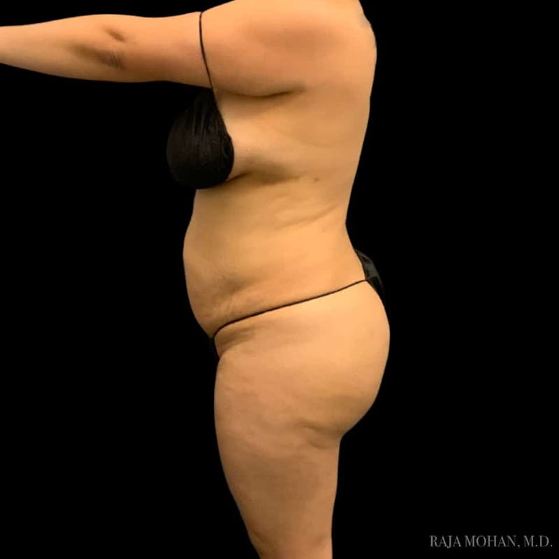 Buttock Augmentation Before & After Gallery - Patient 210253 - Image 86