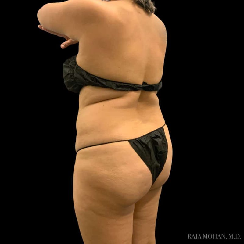 Buttock Augmentation Before & After Gallery - Patient 210253 - Image 87