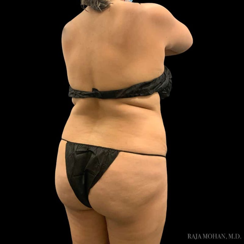 Buttock Augmentation Before & After Gallery - Patient 210253 - Image 89