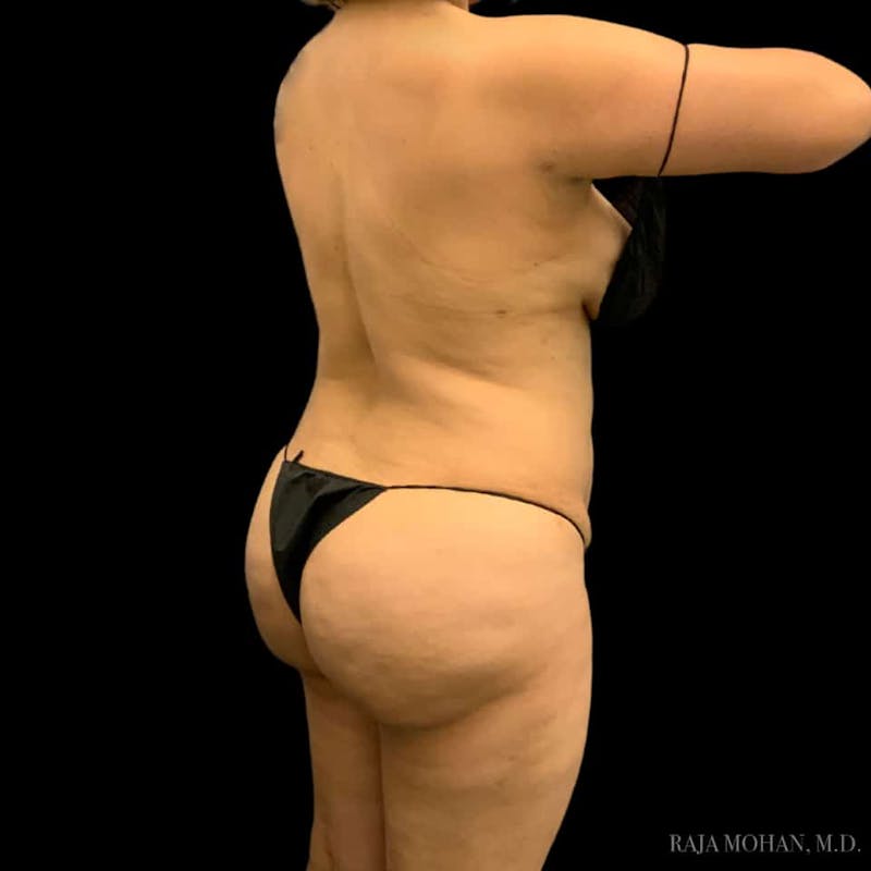 Buttock Augmentation Before & After Gallery - Patient 210253 - Image 90