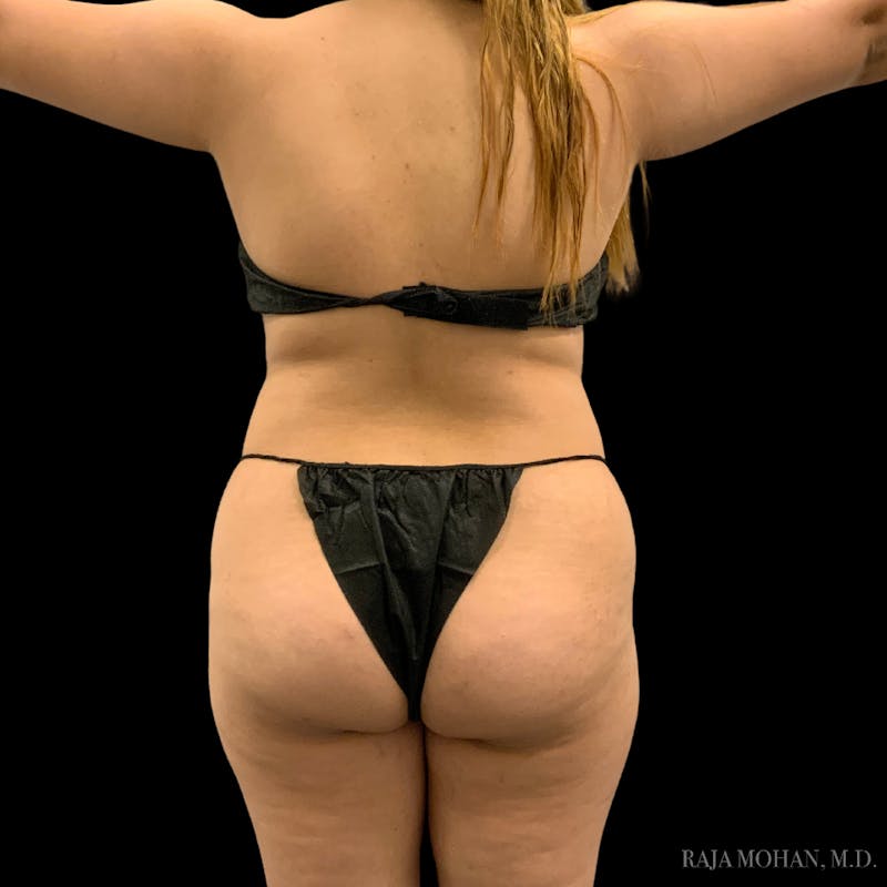 Buttock Augmentation Before & After Gallery - Patient 783815 - Image 1