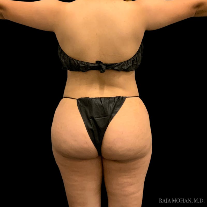 Buttock Augmentation Before & After Gallery - Patient 783815 - Image 2