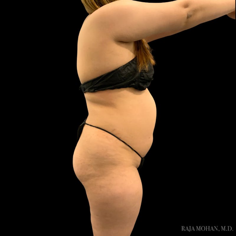 Buttock Augmentation Before & After Gallery - Patient 783815 - Image 3