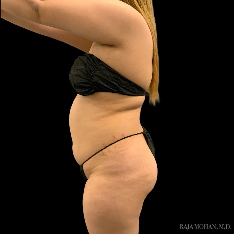 Buttock Augmentation Before & After Gallery - Patient 783815 - Image 5