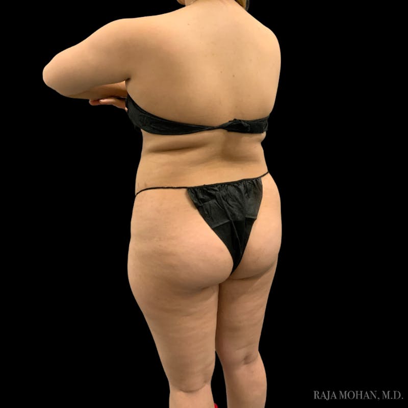 Buttock Augmentation Before & After Gallery - Patient 783815 - Image 7