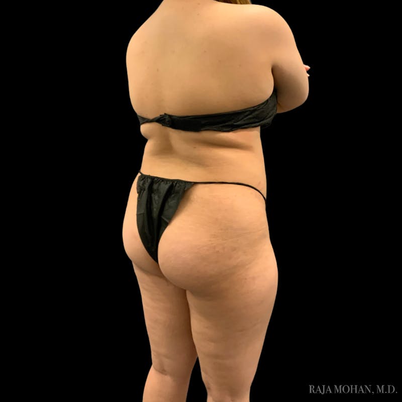 Buttock Augmentation Before & After Gallery - Patient 783815 - Image 9