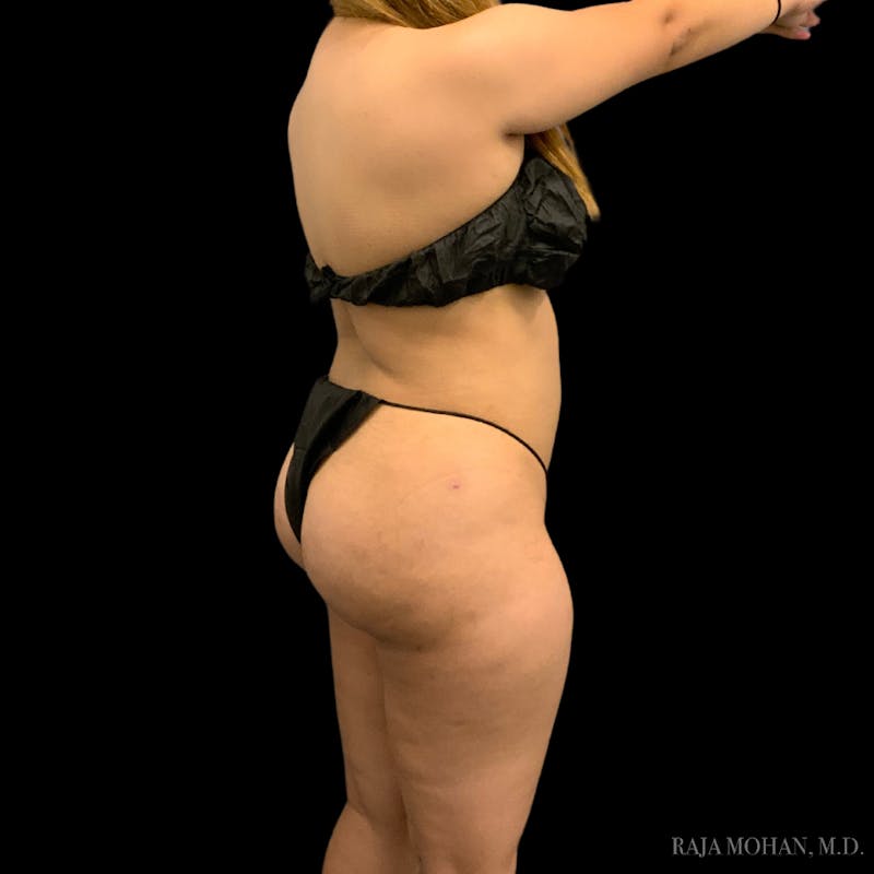 Buttock Augmentation Before & After Gallery - Patient 783815 - Image 10
