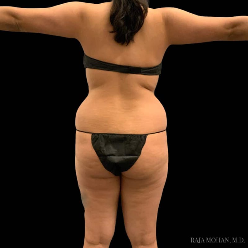 Buttock Augmentation Before & After Gallery - Patient 210253 - Image 101