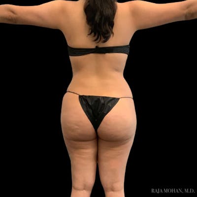 Buttock Augmentation Before & After Gallery - Patient 280276 - Image 2