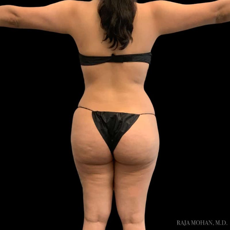 Buttock Augmentation Before & After Gallery - Patient 210253 - Image 102