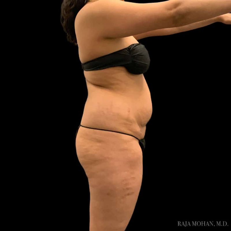 Buttock Augmentation Before & After Gallery - Patient 210253 - Image 103