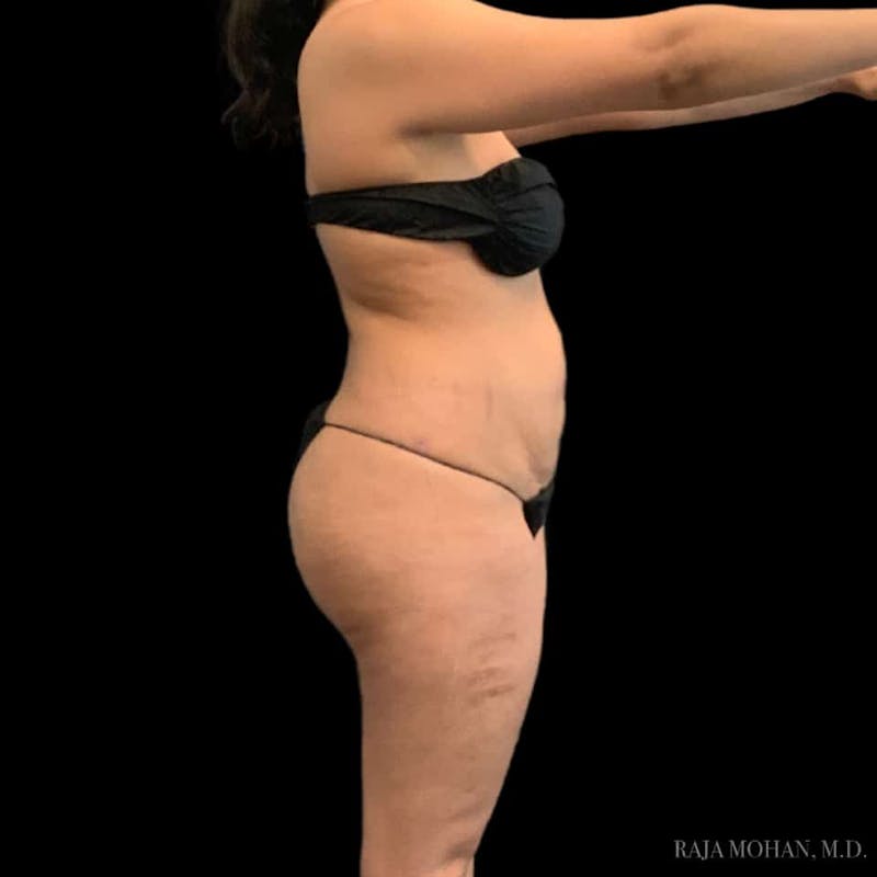 Buttock Augmentation Before & After Gallery - Patient 210253 - Image 104