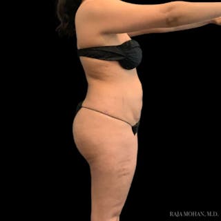 Buttock Augmentation Before & After Gallery - Patient 210253 - Image 104
