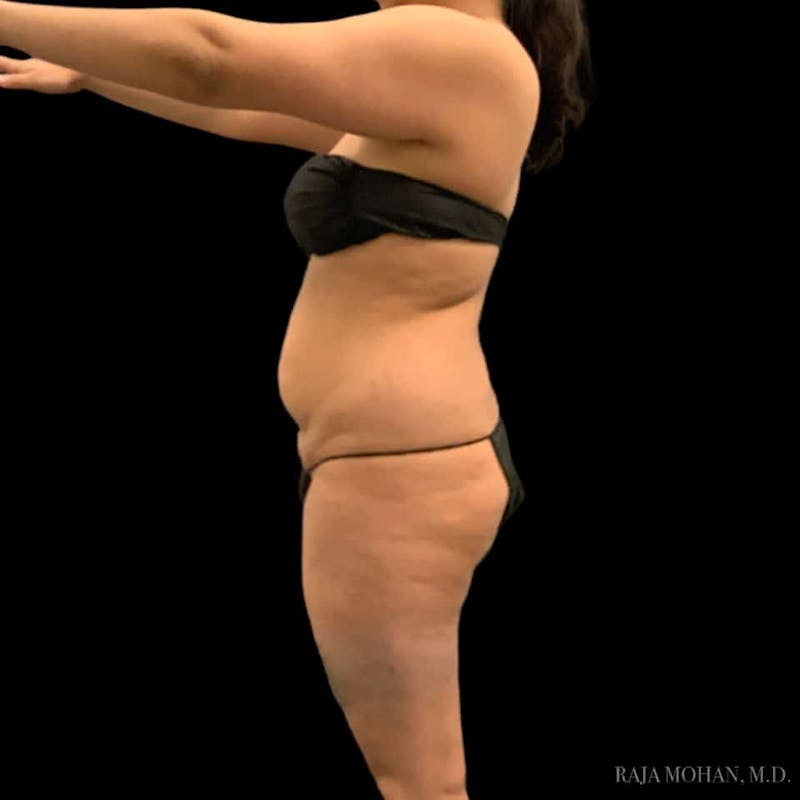 Buttock Augmentation Before & After Gallery - Patient 210253 - Image 105