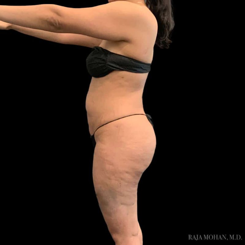 Buttock Augmentation Before & After Gallery - Patient 210253 - Image 106