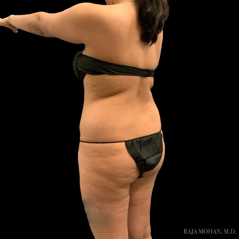 Buttock Augmentation Before & After Gallery - Patient 210253 - Image 107