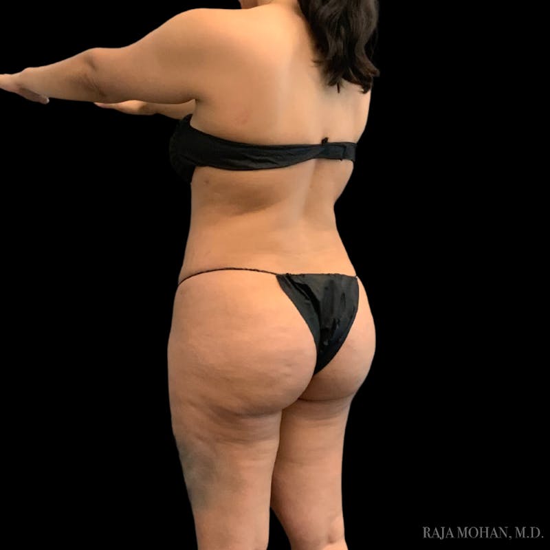Buttock Augmentation Before & After Gallery - Patient 210253 - Image 108