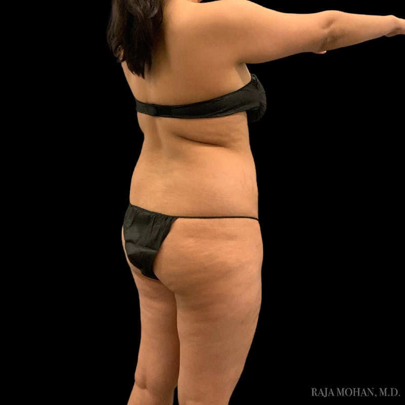 Buttock Augmentation Before & After Gallery - Patient 210253 - Image 109