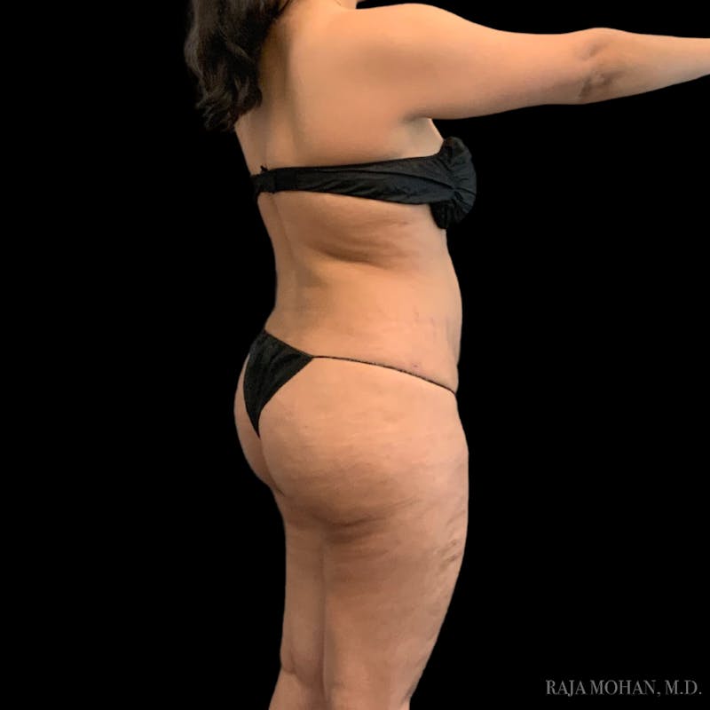 Buttock Augmentation Before & After Gallery - Patient 210253 - Image 110
