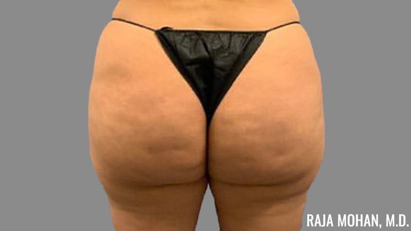Buttock Augmentation Before & After Gallery - Patient 210253 - Image 111