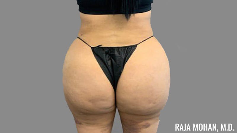Buttock Augmentation Before & After Gallery - Patient 210253 - Image 112