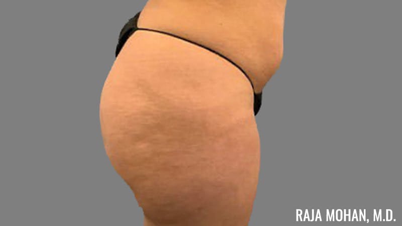 Buttock Augmentation Before & After Gallery - Patient 210253 - Image 113
