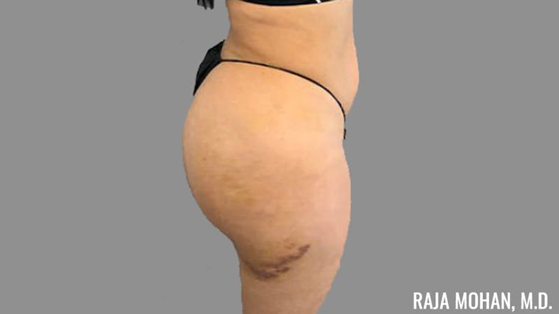 Buttock Augmentation Before & After Gallery - Patient 210253 - Image 114