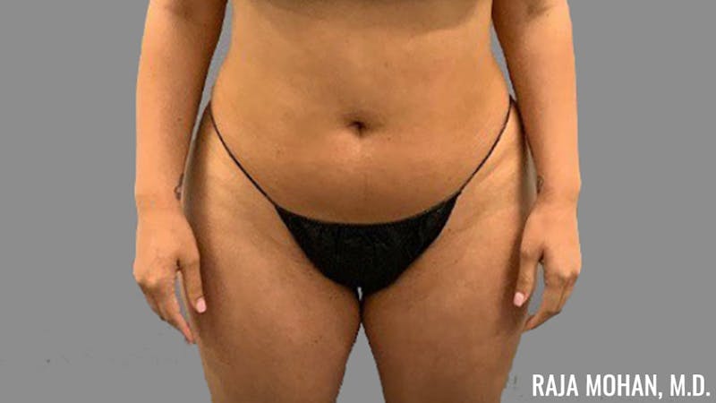 Buttock Augmentation Before & After Gallery - Patient 210253 - Image 115