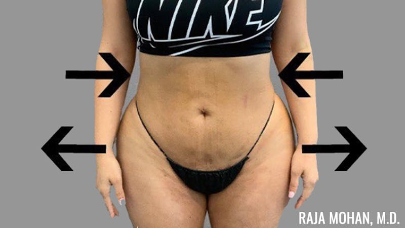 Buttock Augmentation Before & After Gallery - Patient 210253 - Image 116