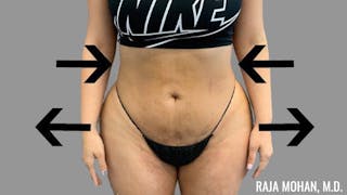 Buttock Augmentation Before & After Gallery - Patient 210253 - Image 116
