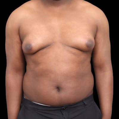 Gynecomastia Before & After Gallery - Patient 175963 - Image 1