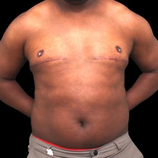 Gynecomastia Before & After Gallery - Patient 175963 - Image 2