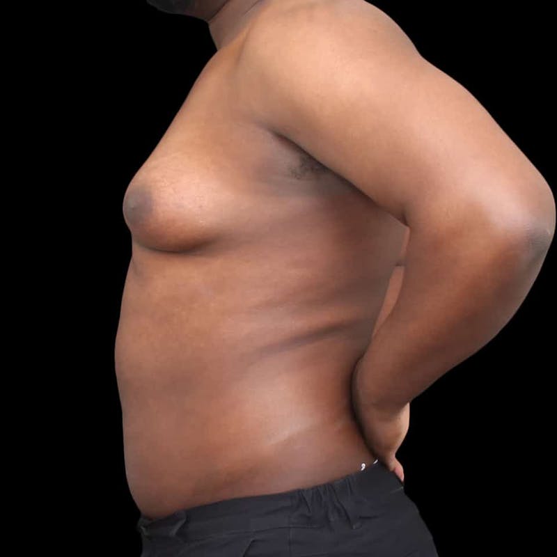 Gynecomastia Before & After Gallery - Patient 175963 - Image 3