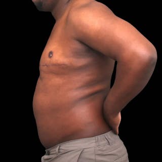 Gynecomastia Before & After Gallery - Patient 175963 - Image 4