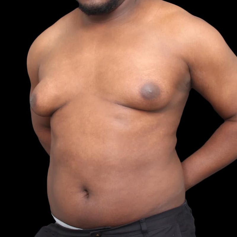 Gynecomastia Before & After Gallery - Patient 175963 - Image 5