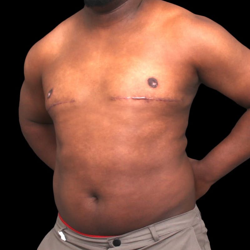 Gynecomastia Before & After Gallery - Patient 175963 - Image 6