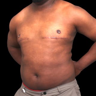 Gynecomastia Before & After Gallery - Patient 175963 - Image 6
